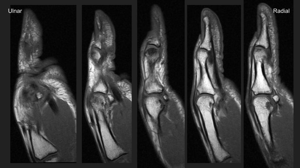 Figure 2 for case annular pulley of finger ( RID2435 )